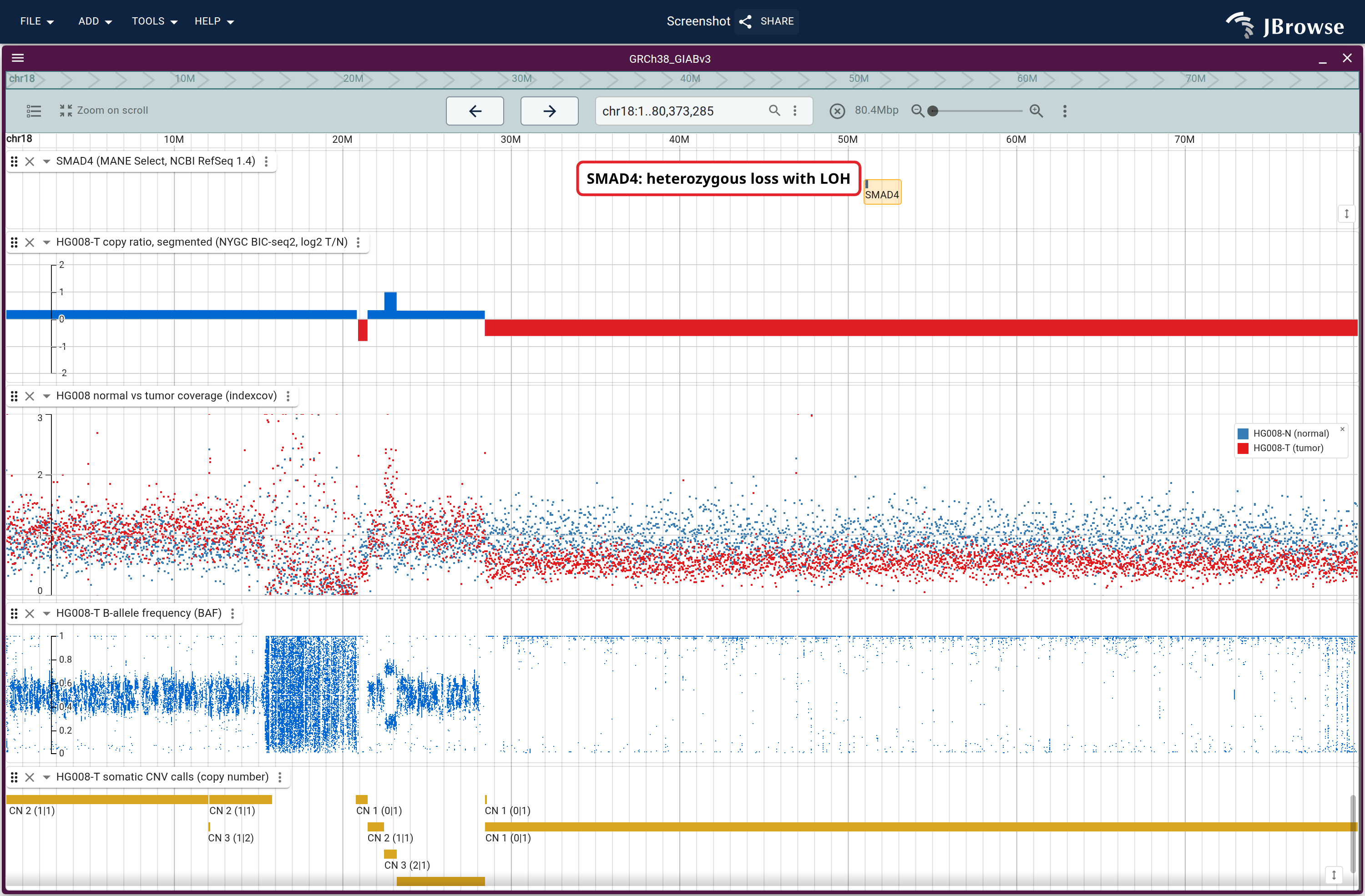Chromosome 18: SMAD4's MANE Select transcript over the segmented copy ratio, the tumor and its matched normal from indexcov, and the BAF, above the CNV calls. All three lanes change together from ~30 Mb to the telomere.